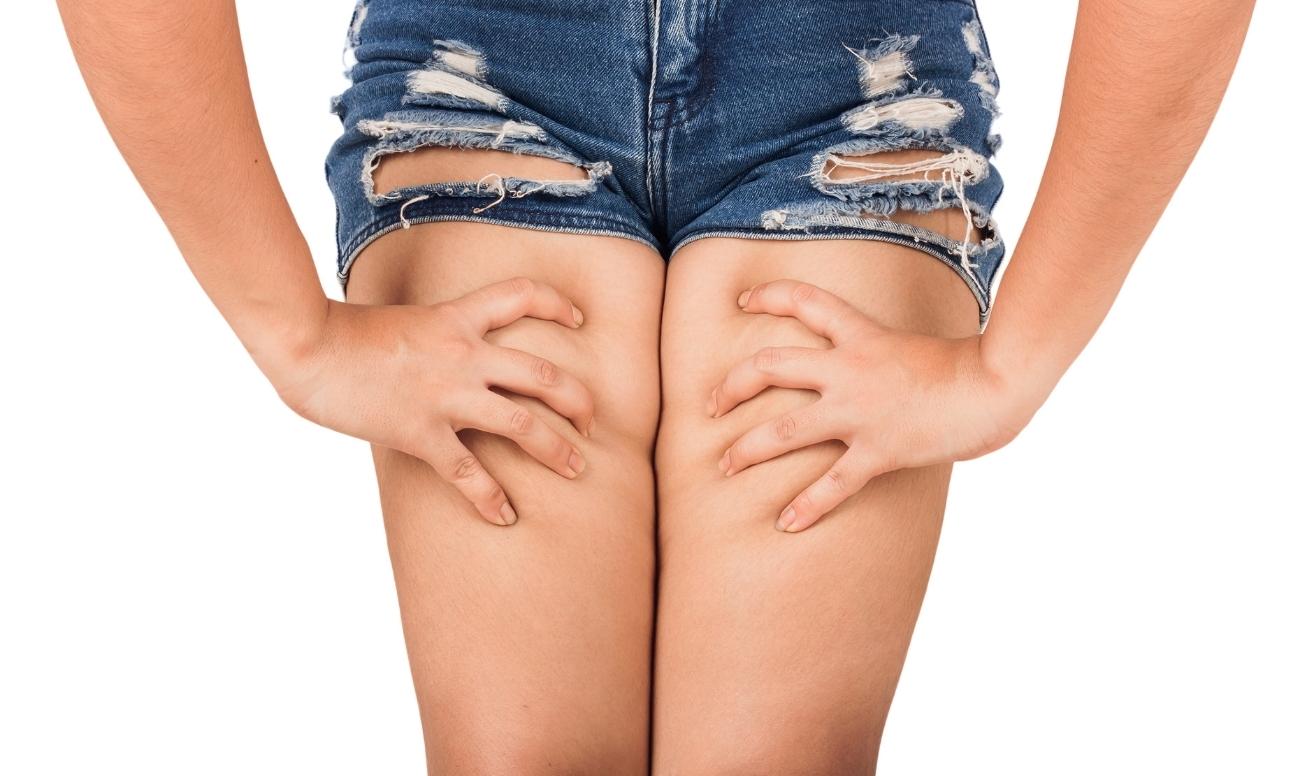 Una ragazza mostra le sue gambe per affrontare le differenze tra cellulite e ritenzione idrica