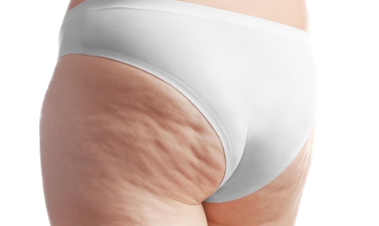 Analisi dei glutei di una donna per spiegare le differenze tra cellulite e ritenzione idrica